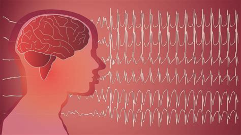 Seizure Disorder : Overview, Causes, Symptoms, Treatment - illness.com