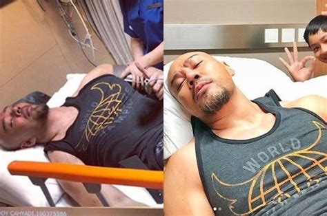 Alami Kecelakaan Sehabis Latihan Di Gym Tulang Lengan Atas Deddy