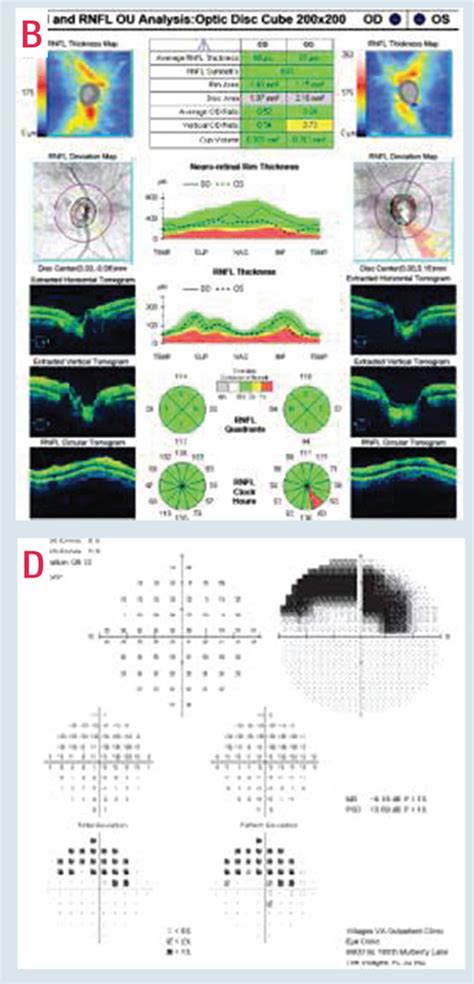 10 2 Visual Field Testing A Tool For All Glaucoma Stages