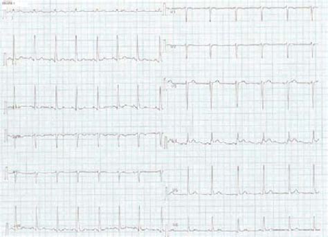 Figure 2 From Solitary Papillary Muscle Hypertrophy A New Echo