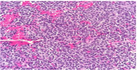 Cellular Tumor Composed Of Undifferentiated Cells Consists Of Small