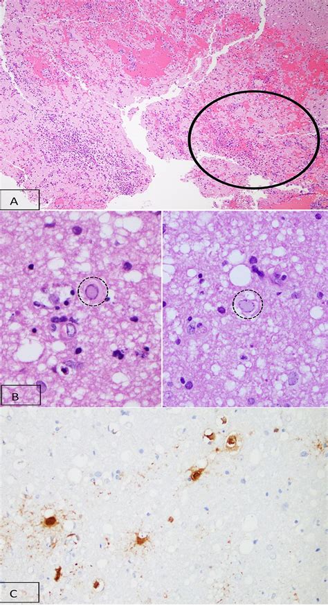 Histopathology Of Brain Biopsy A H E Stain At 40x Magnification Shows