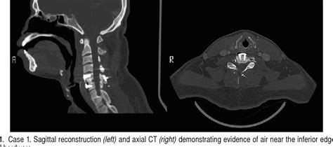 Figure From Management Of Delayed Esophageal Perforations After