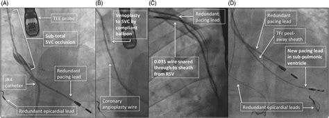 Stages of the procedure. (A) Venogram of SVC occlusion. (B) Venoplasty ...