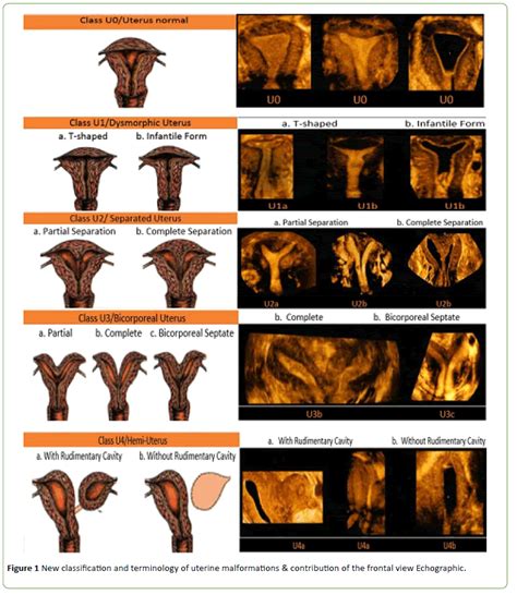 Uterine Myoma In A Rudimentary Horn Miming An Adnexal Neoplasm In