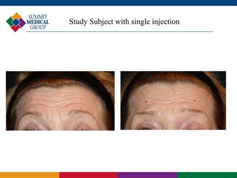 Minimally Invasive Techniques In Facial Rejuvenation Ppt