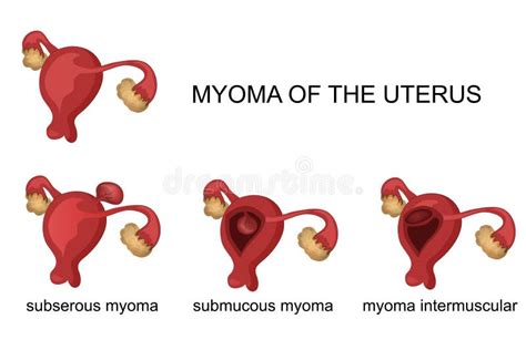 Myoma Of The Uterus Stock Vector Illustration Of Gynaecology 74502819