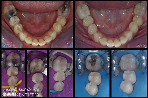 Restorations Before-After | Andrew Middlemiss Dentistry - Wellington CBD