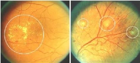 A human Eye with Diabetic Retinopathy (a)Hard Exudates (b)Soft Exudates ...