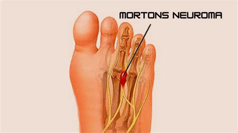 Neuroma Mortons Treatment - Best Surgery Specialist Near Me