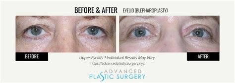 Eyelid Surgery In Scarsdale Westchester Dr Sal Farruggio