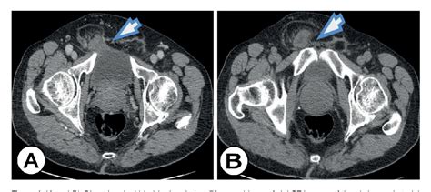 Figure 1 From Imaging Of Inguino Scrotal Urinary Bladder Hernias