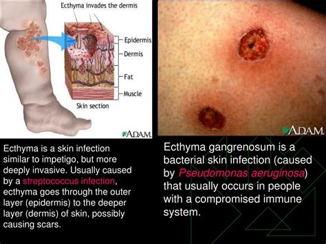 PPT - Bacterial Skin Infections PowerPoint Presentation, free download ...