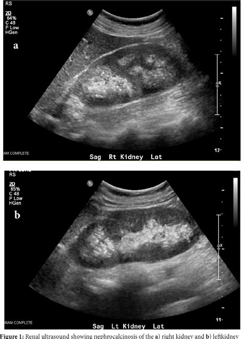 Figure 1 From Medullary Sponge Kidney With Distal Renal Tubular