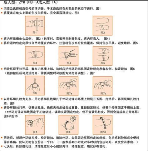 包皮上环手术具体是怎样脱落的详细图片过程 百度知道