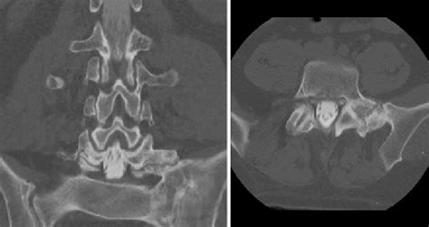 Computed Tomography Myelogram Obtained In A Patient With A Lumbosacral Download Scientific