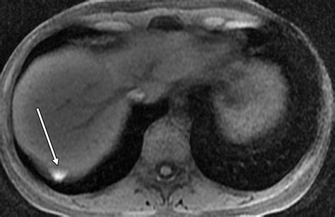 Atypical Sites Of Deeply Infiltrative Endometriosis Clinical Characteristics And Imaging