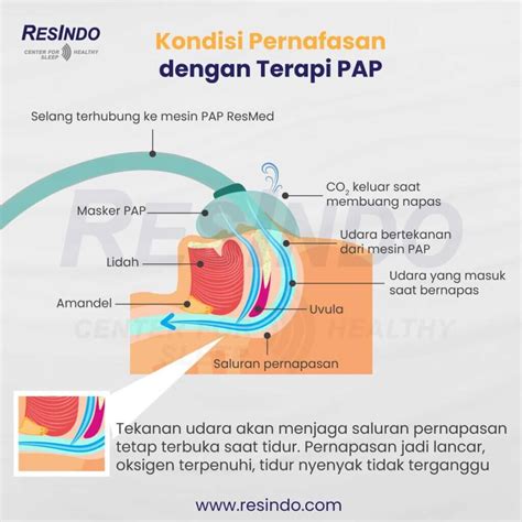 Sleep Apnea Penjelasan Penyebab Gejala Risiko Serta Cara