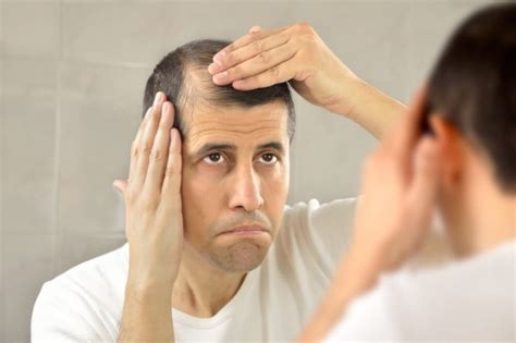 Androgenic Alopecia Symptoms Causes And Treatment Step To Health