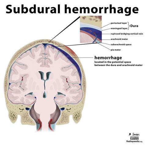 Unterscheidung Epidurales H Matom Subdurales H Matom Pacs