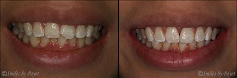 Cosmetic Dentistry Smiles By Payet Dentistry Cosmetic Dentist Charlotte