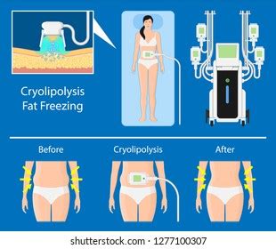 Peritoneal Dialysis Vector Illustration Labeled Scheme 스톡 벡터 로열티 프리