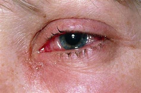 La Alergia De Los Ojos Conjuntivitis Alérgica Dr Giménez