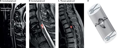 Spinal Cord Injury Mri