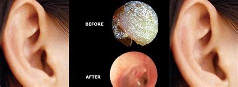 Ear Blockage Treatment Service at best price in Raigad | ID: 18338498612