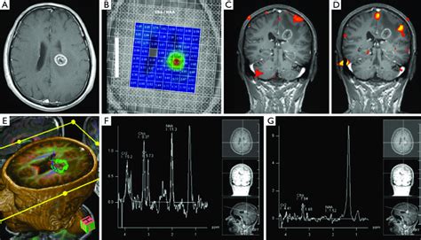 Left Frontal Lobe Gbm A Axial T Post Gadolinium Administration B