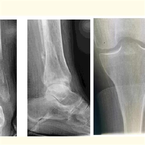 AP and lateral views with fractured medial malleolus and a compound ...