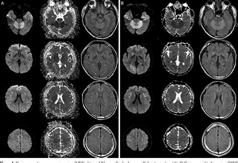 Figure 1 from Serial MRI of Hypoxic Brain Damage after Hydrogen Sulfide ...