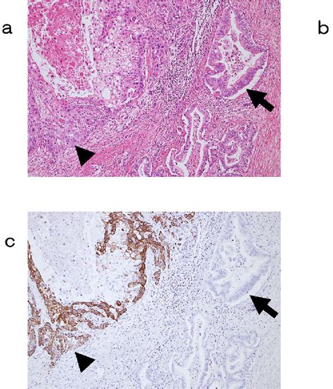 He Staining Of Adenosquamous Carcinoma A The Adenocarcinoma