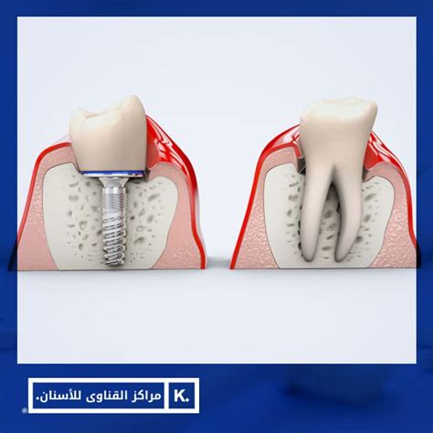 اسعار زراعة الاسنان فى مصر الدكتور محمد القناوي استاذ زراعه الاسنان