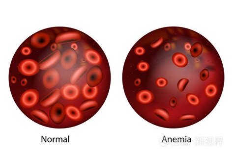 缺铁性贫血。红细胞贫血量与正常血细胞的差异插画 正版商用图片0f0640 摄图新视界