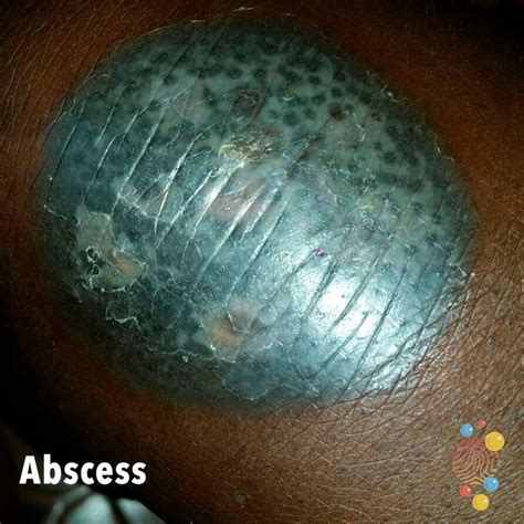 Skin Abscess Types