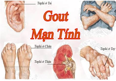 thuốc gout rox Y TẾ SỈ ĐỒNG NAI