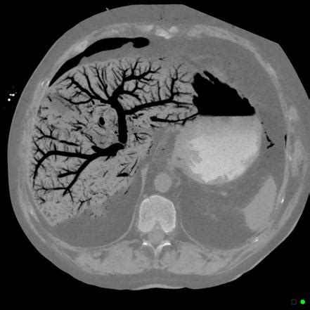 Portal Venous Gas Radiology Reference Article Radiopaedia Org