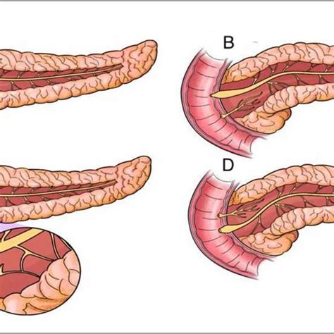 Plastic Stent Yellow Arrow Placed In Dorsal Pancreatic Duct After