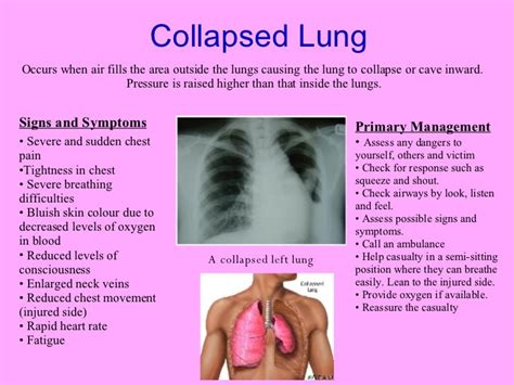 Chest Injuries