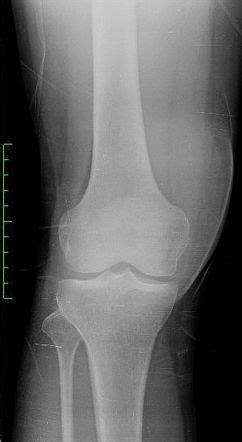 Prepatellar Bursitis Image Radiopaedia Org