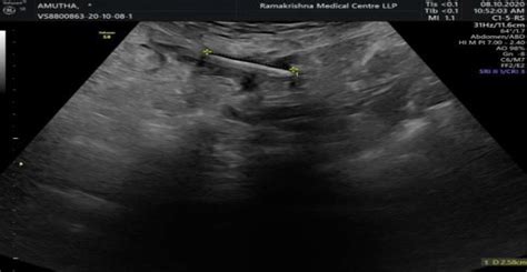 Ultrasound Image Depicting Transmigrated Copper T Download Scientific Diagram