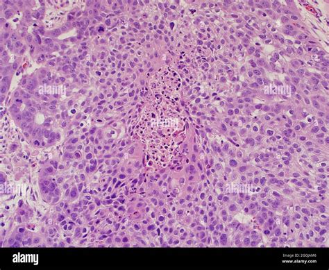 Lung cancer : pulmonary keratinizing squamous cell carcinoma associated ...