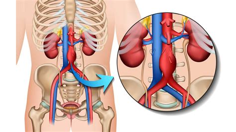 An Vrismes De Laorte Abdominale Acveq