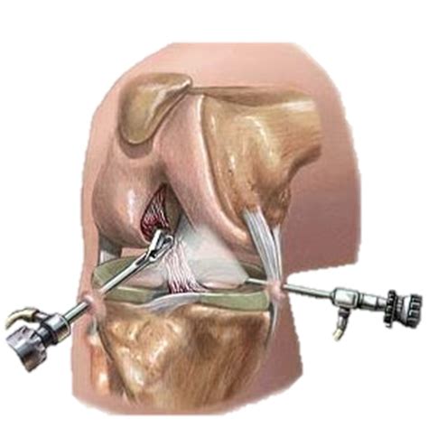 Artroscopia De Rodilla Procedimiento Beneficios Recuperaci N Dr