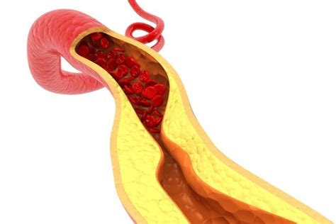 Study Finds Cholesterol Levels Rise Significantly Before Menopause In