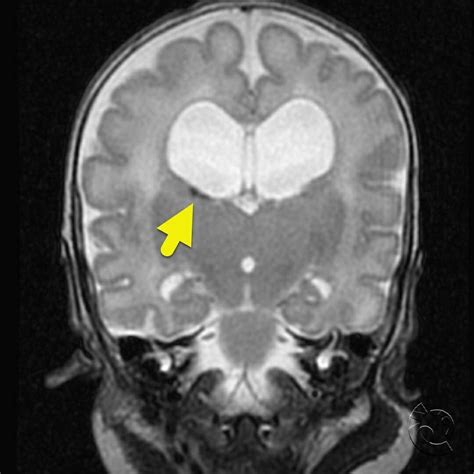 Germinal Matrix Hemorrhage Grade 1