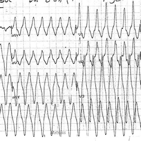 Ecg Shows Wide Qrs Tachycardia Rbbb Northwest Axis Rate 180min So Download Scientific