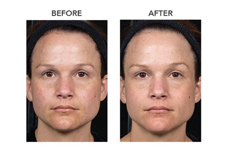 Clear Brilliant Laser Treatments At Laser Skin Institute Chatam Nj