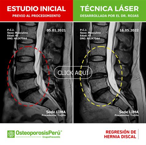 Regresi N De Hernia Discal Rx Osteoporosis Per